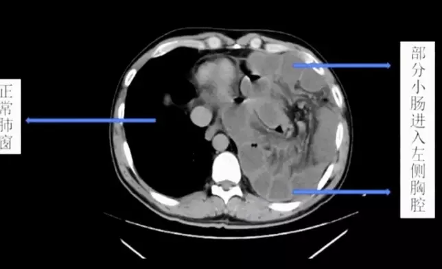 腹腔壓力突然升高或漸升就會造成膈肌破裂，破裂以後小腸就鑽進胸腔近2米。網上截圖