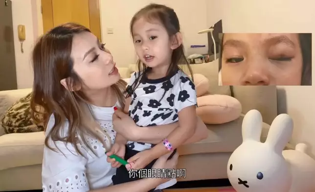 Yan表示女兒眼睛縫了兩針，兩星期便會退腫。