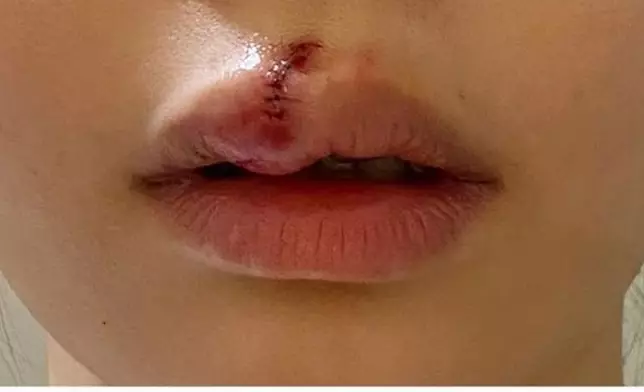 Aka去年被流浪狗咬傷嘴唇。