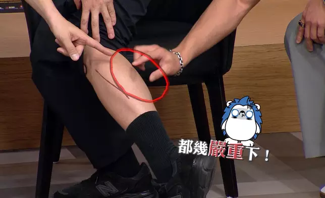 劉俊謙拍攝期間不小心被電單車死氣喉燙傷。