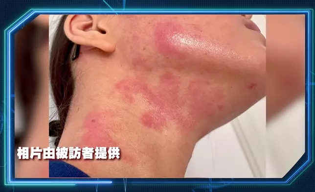素人阿Yan長期飽受嚴重濕疹困擾。