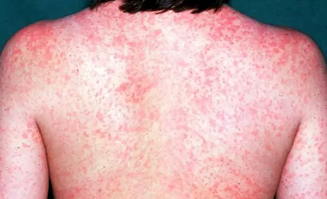 麻疹。資料圖片