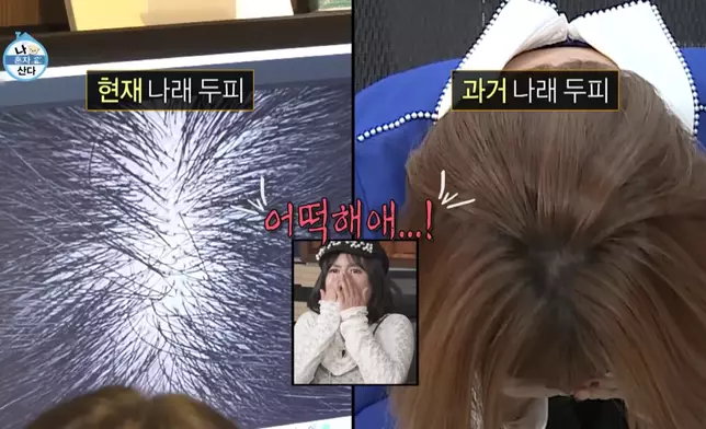 朴娜勑對於頭皮脫出感到很害羞。 影片截圖