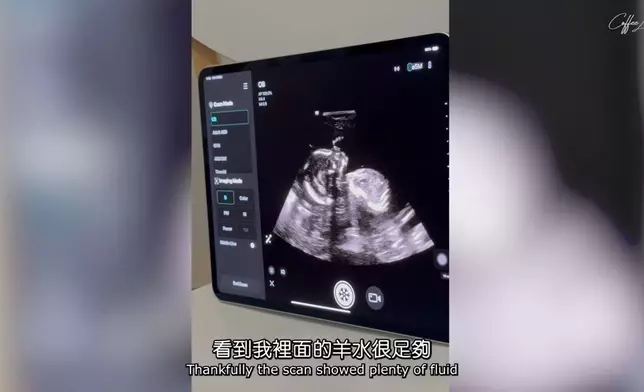 再次檢查亦顯示羊水充足。