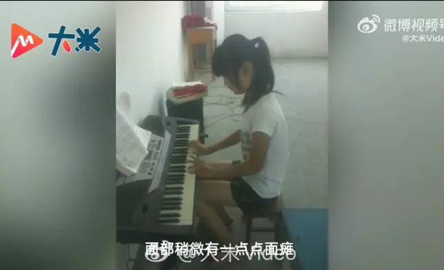 女子早產三度病危，奇蹟存活卻留永久性視障及肢體障礙。影片截圖