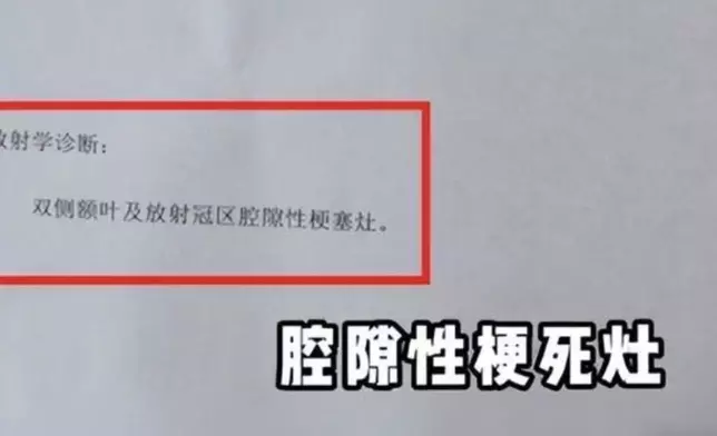 名醫自曝確診腦梗，懷疑「過勞」是唯一元兇。影片截圖