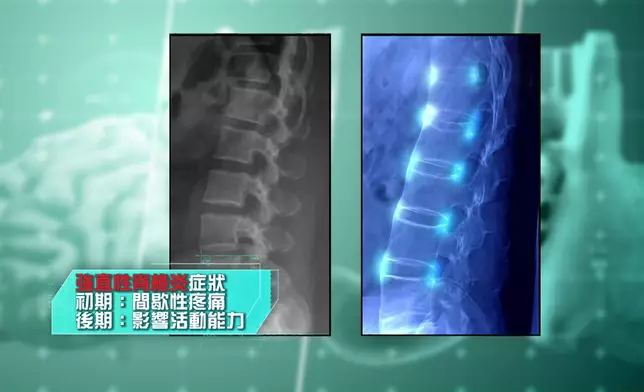 余嘉龍醫生解釋「強直性脊椎炎」的特徵和症狀。
