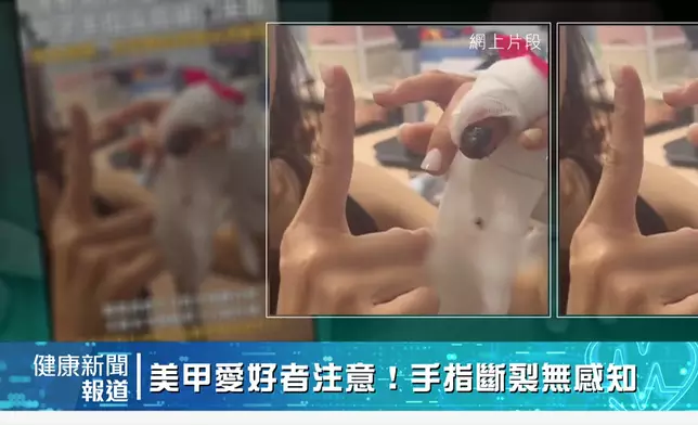 恐怖慎入！今晚其中一則新聞，會講解一名女子被夾斷手指都懵然不知。