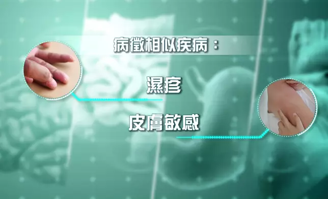 延伸分析這個和濕疹類似的病，有四個獨特的出疹位置，可能是患上「皮肌炎」的警號！
