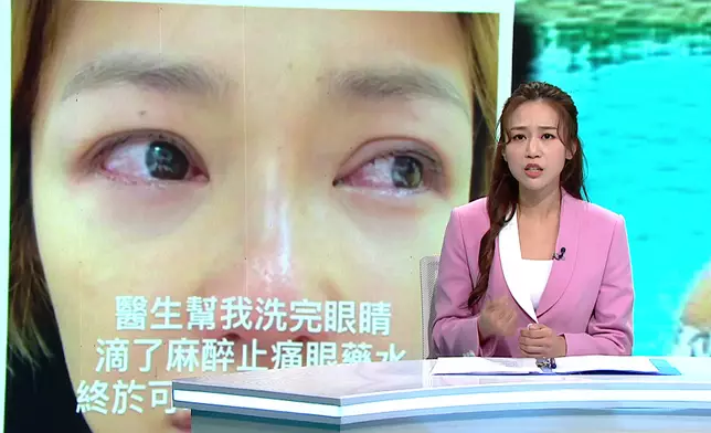 倪晨曦早前出post指自己敷面膜期間異物入眼，導致雙眼疼痛通紅、眼皮浮腫兼流眼水。