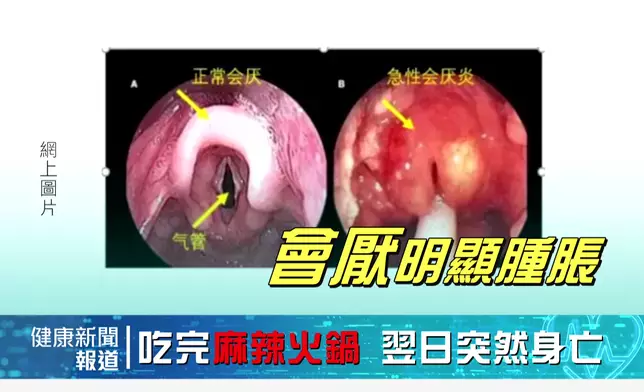 另一重點新聞，打邊爐食死人—26歲女由求診到死亡僅10分鐘。