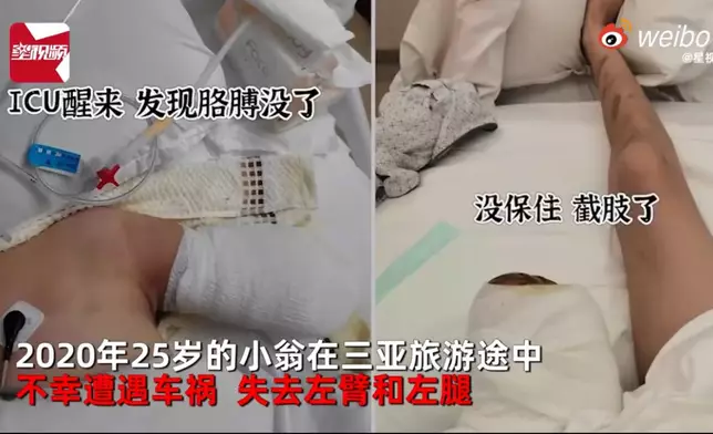 女生遇車禍失左臂左腿，3年後創辦工廠助殘障人士自立生活。影片截圖