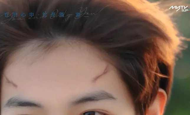 柏然額頭上的神秘疤痕