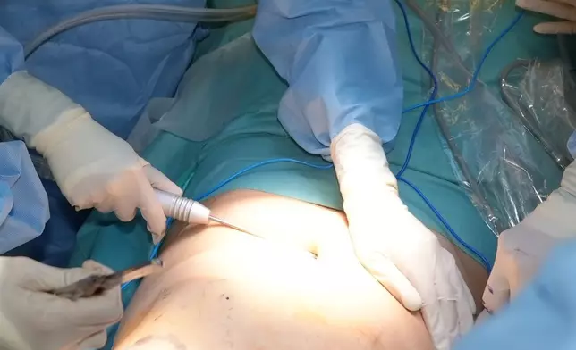 此項臨床試驗在乳房保留手術中即時結合自體脂肪移植技術重塑乳房，該技術從患者身體脂肪較多的部位抽取脂肪，經處理後再注射至乳房。