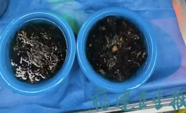 女童患「長髮公主綜合症」，就醫從胃中取出兩大盆頭髮。網上圖片