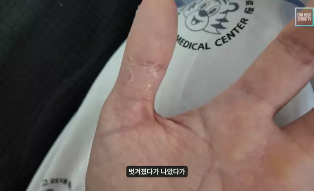 車炫承大方展示治療狀況。影片截圖