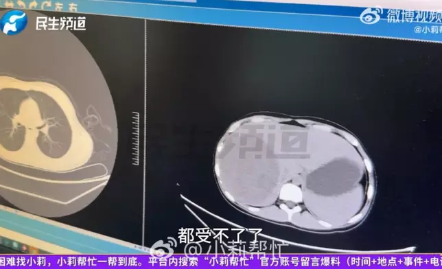 少女求醫確診末期肝癌，醫生懷疑不良飲食習慣是主因。影片截圖