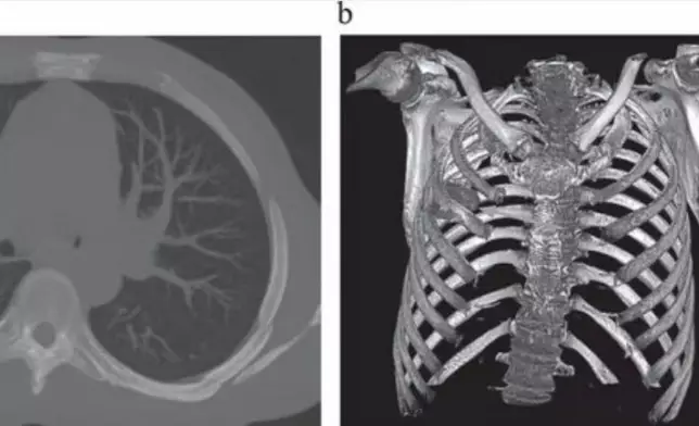 男子照X光揭刀插胸腔內長達8年。網上圖片@academic.oup.com