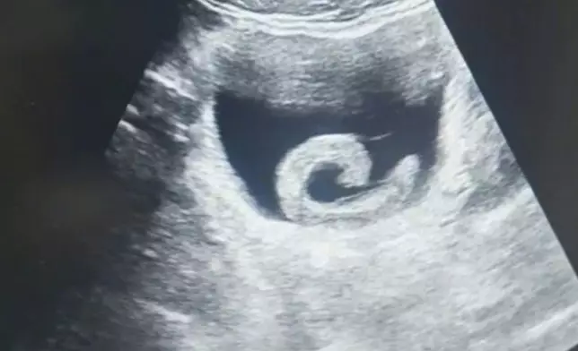 男子誤信偏方塞5CM活水蛭入尿道遭鑽入膀胱吸血痛到急就醫。影片截圖