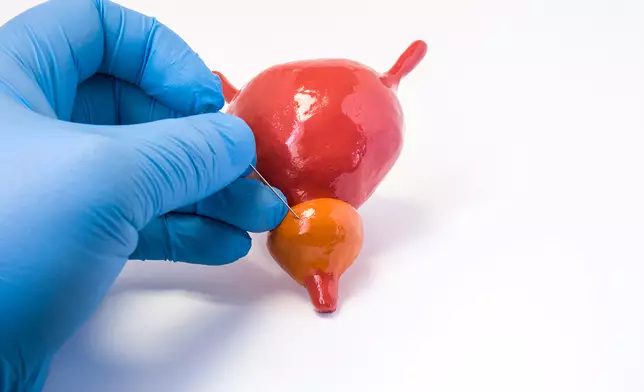 前列腺癌已躍升為男性第三大常見癌症，新症數字連年上升。Getty設計圖片