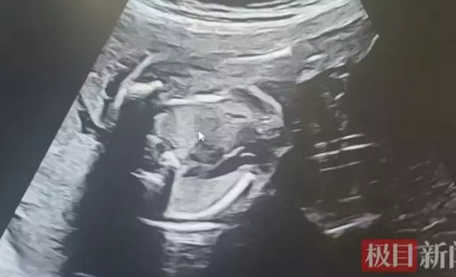 孕婦罹患雙胞胎卻確診雙胎輸血綜合症，獲醫生延長孕周終平安分娩。網上圖片