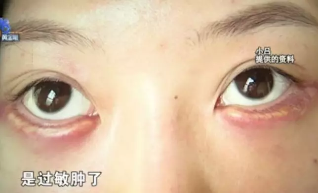女子面部注射填充物嚴重過敏腫脹，修復過程中又遭美容院職員擠爆臥蠶致視力受影響。影片截圖