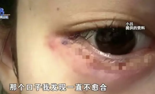 女子面部注射填充物嚴重過敏腫脹，修復過程中又遭美容院職員擠爆臥蠶致視力受影響。影片截圖