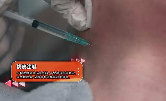 醫生在Ada臉上注入肉毒杆菌素。