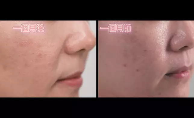 Ada展示注射前後的分別。