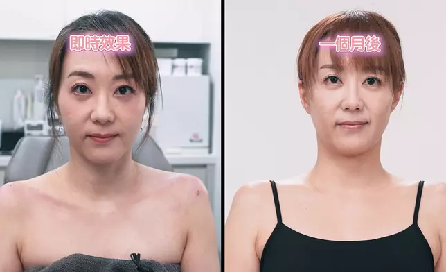 Ada接受醫美前後的對比。