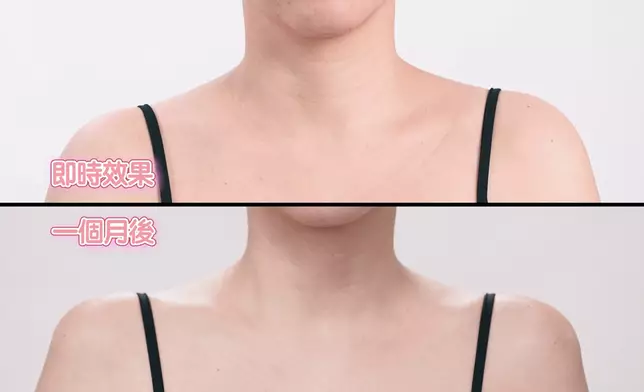 Ada接受醫美前後的對比。