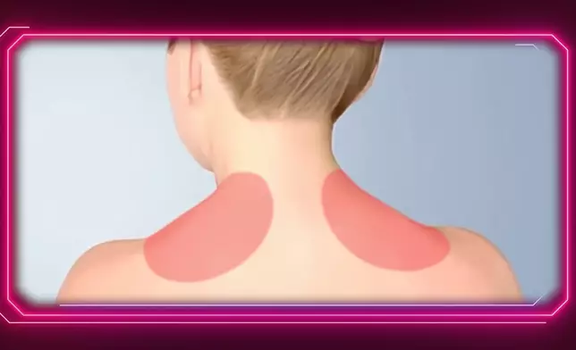 利用肉毒桿菌放鬆肩頸間的斜方肌。