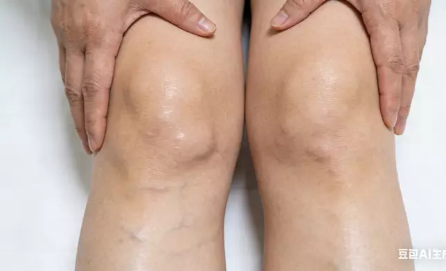 回南天濕氣重易水腫，中醫教如何辨別浮腫與肥胖。AI生成圖片