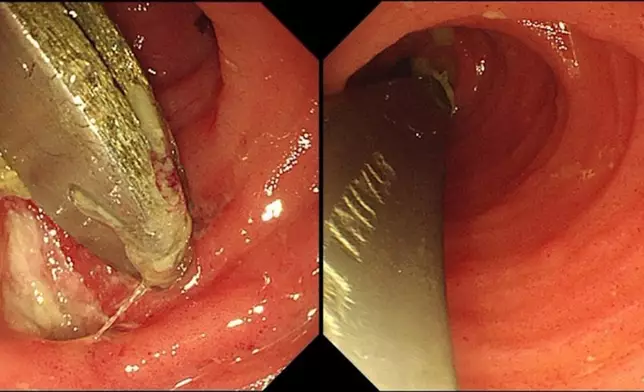 男子腹痛1周求醫揭腸道內藏兩把匙羹險造成穿孔。網上圖片