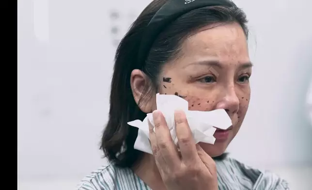 Jenny因年齡關係要接受14針「埋線」。