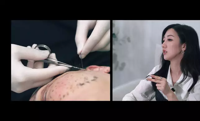 Jenny因年齡關係要接受14針「埋線」。