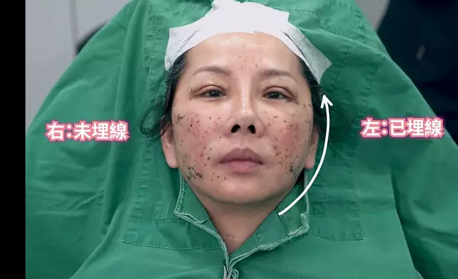 接受「埋線」醫美前後的對比很明顯。