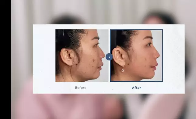 接受「埋線」醫美前後的對比很明顯。