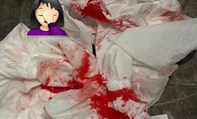 哂出多張染血紙巾