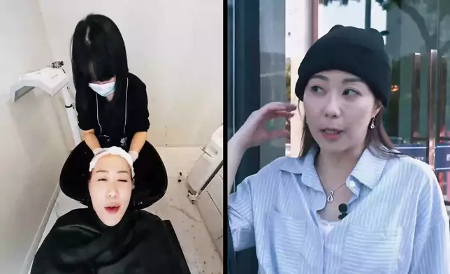 Ada抽取自身毛囊殖入前額。