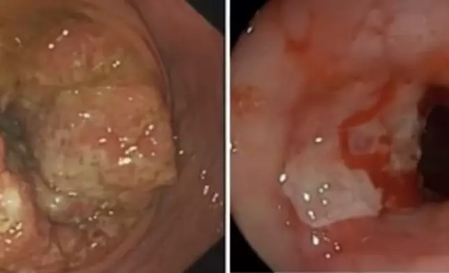 少女腹痛半年誤當痛經，求醫確診晚期腸癌揭家族遺傳病因。網上圖片