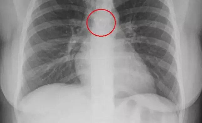 女子咳嗽1個月未見好轉求醫揭鼻環誤入肺部僅距主動脈0.5毫米險死。TikTok圖片