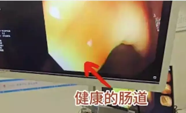 婦人便秘10年長期靠通便茶紓緩導致腸道變「豹紋腸」病變壞死需切除30CM。影片截圖