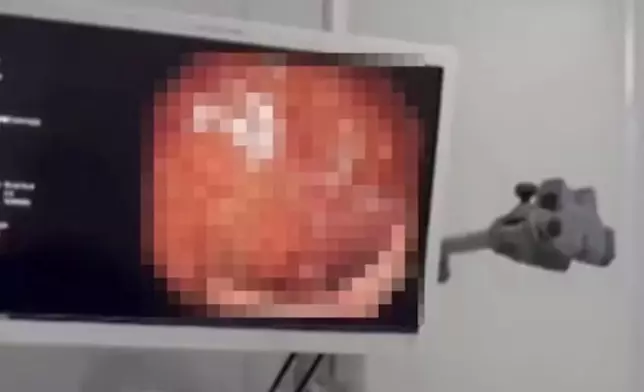 婦人便秘10年長期靠通便茶紓緩導致腸道變「豹紋腸」病變壞死需切除30CM。影片截圖