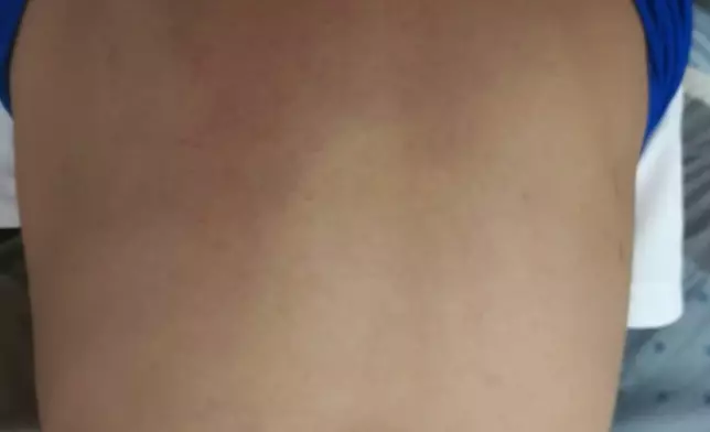 有人在社交媒體展示傷勢。Threads圖片