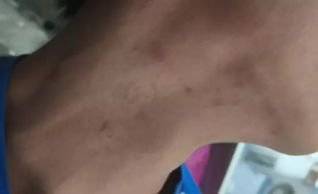 有人在社交媒體展示傷勢。Threads圖片