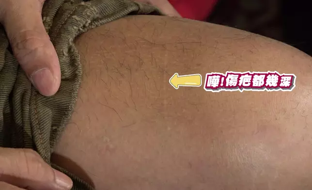 小豬曾被同學箍頸、剪頭髮及用圓規𠝹傷大髀，疤痕仍在。