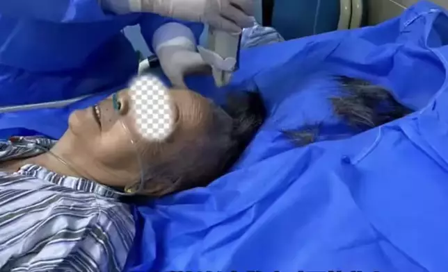 7旬婆婆墮池塘後出現乏力發燒，送院揭身藏17隻蜱蟲。影片截圖