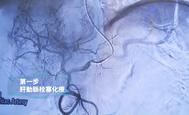 解構「先縮後除」肝癌治療新技術三大步驟。
