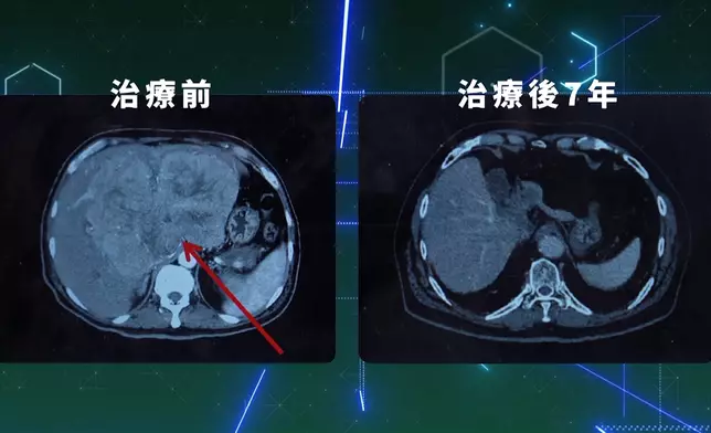 解構「先縮後除」肝癌治療新技術三大步驟。
